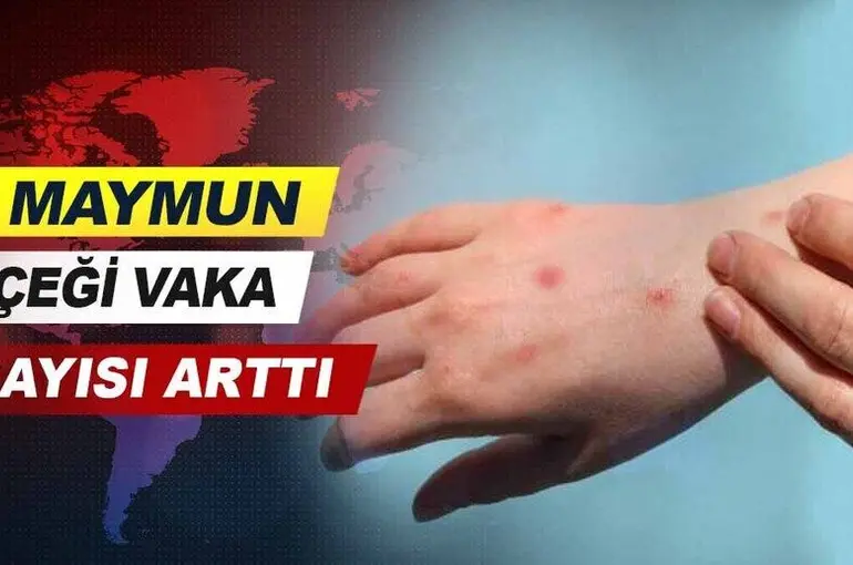 Maymun çiçeği vaka sayısında son durum belli oldu