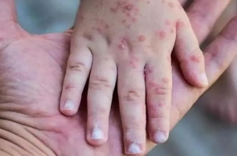 Maymun çiçeği virüsü için aşıya gerek var mı?